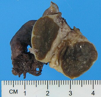 Typical gross pathology of a Leydig cell tumor (in this case of the ovary): A well circumscribed, solid homogeneous mass with golden brown to brownish green cut surface.[12]