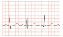 Tachycardia_ECG_paper.svg