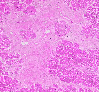 Interstitial fibrosis of chronic ischemic heart disease, H&E stain, with associated relatively well organized myocardial bundles