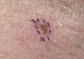 Melanoma in situ, evolving, right clavicle marked for biopsy