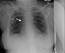 Carcinoid tumor, typical - Case 303 (49030234728).jpg