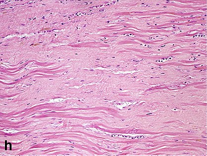 Replacement fibrosis in myocardial infarction, typically being boundless, dense and not conforming to the other types.