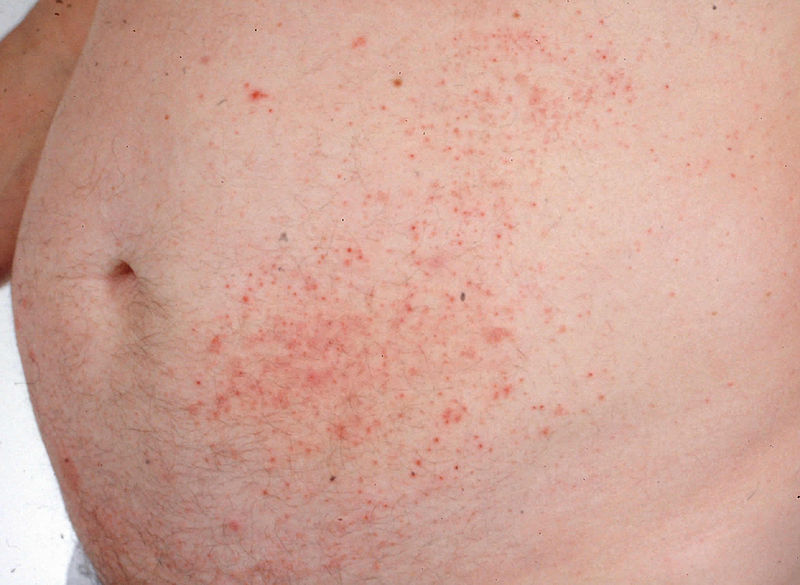 File:Dermatitis Herpetiforme 4.jpg