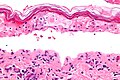 Necrosi epidermica confluente, con alto livello di magnesio.