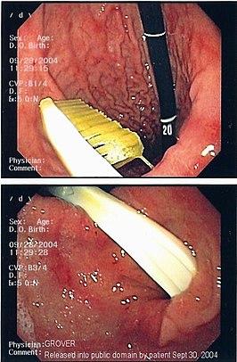 Endoscopie afbeelding van een tandenborstel in het lichaam van een mens