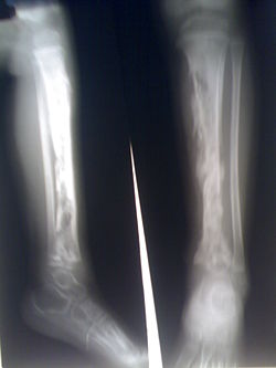 Ostermyelitis Tibia.jpg