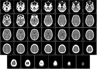 Computed tomography of human brain. Public Domain, by Mikael Häggström with assistance from the Department of Radiology, Uppsala University Hospital