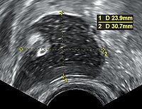 Dermoid cyst