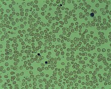 Description de l'image Delta Beta Thalassemia.jpg.