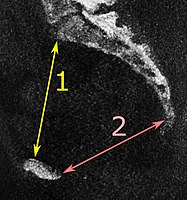 Low dose CT for pelvimetry