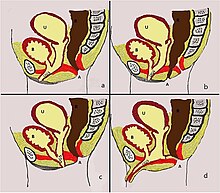 a Blijvende sinus urogenitalis. b De cloacale variant. c Posterieure cloacale variant. d Blijvende sinus urogenitalis met rectovaginale fistel