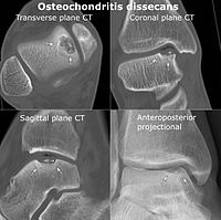 Osteochondritis dissecans