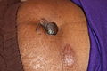 Pedunculated umblical keloid