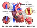 Coronary artery bypass graft