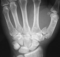 Fracture of the first metacarpal (Rolando's fracture).