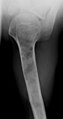 X-ray showing enchondromas localized in the humerus of a 37-year-old patient affected with Ollier disease