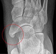 Cornuate navicular bone