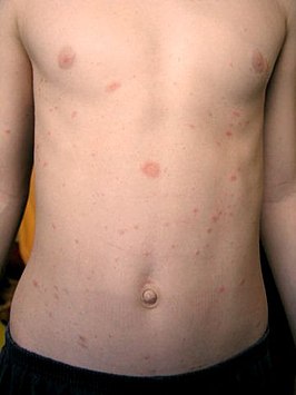 pityriasis rosea, verdeling plekjes met 'tâche mère'