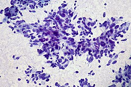 Carcinoid tumor - FNA Case 169 (5568987294).jpg