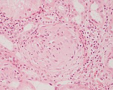 April 25: stain showing signs of Glomerulonephritis