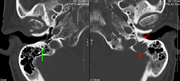 CT mozga otkriva je razlagajuću leziju na lijevoj sljepoočnoj kosti (desna strana slike) i petrozni dio sljepoočne kosti koje zahvataju mastoidni segment kanala facijalnog nerva. Crvene strelice: lezija; zelena strelica: normalan kontralateralni kanal facijalnog živca. Lezije su u skladu sa naslagama mijeloma.