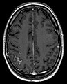 Meningeal carcinomatosis in a patient with breast cancer (contrast-enhanced axial T1-weighted MRI)