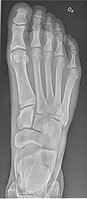 Normal foot, dorsoplantar projection