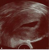 Normal sonohysterography