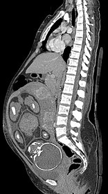 Median plane, with a pregnancy