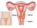 Cervical cancer