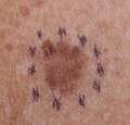 Melanoma in situ, right anterior shoulder marked for biopsy