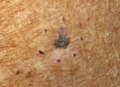 Melanoma gaiztoa, atzeko eskuineko sorbalda zirkuluan, biopsiarako