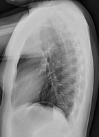 Normal chest radiograph, lateral view