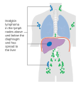 Stage 4 Hodgkin lymphoma