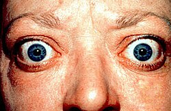 Proptosis and lid retraction from Graves' Disease.jpg