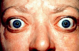 Description de l'image Proptosis and lid retraction from Graves' Disease.jpg.