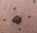 Melanoma gaiztoa, eskuin erdiko izterra, biopsiarako markatua