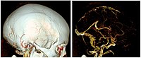 CT without and with bone removal