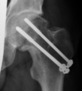 fractura collum femoris, cancellous screws