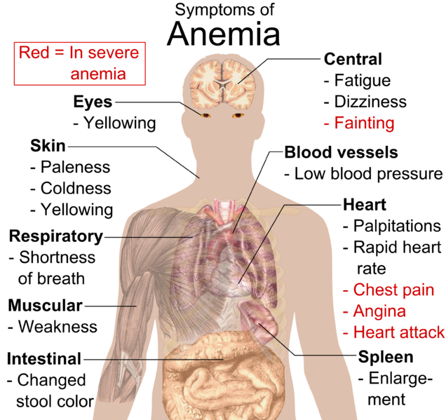 File:Symptoms of anemia.png