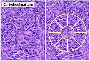 Cartwheel pattern: Center points that radiate cells or connective tissue outward