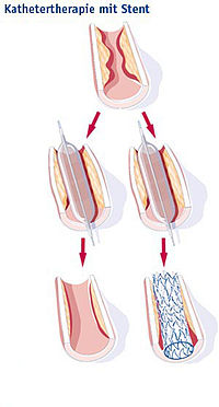 Till vänster en ballongutvidgning, till höger har en stent placeras i ett blodkärl.
