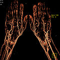 CT-Angiographie der Hände