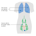 Stage 4B vulvar cancer