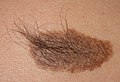 Becker's nevus