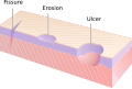 Ulcers, fissures, and erosions