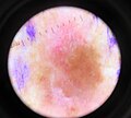 Melanoma gaiztoa, ezkerraldean biopsia egiteko markatuta, dermatoskopioaren bidez.