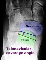 Talonavicular coverage angle