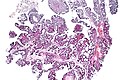 Papillary urothelial carcinoma with cribriform morphology, low mag