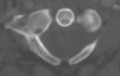 Posterior arch defect of C1